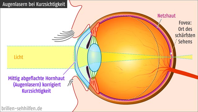 Augenlaserbehandlung bei Kurzsichtigkeit (Myopie)