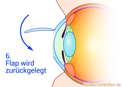 Augenkorrketur - Flap zurück