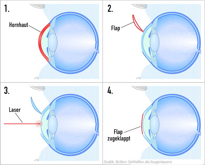 Augenlasern Verfahren LASIK