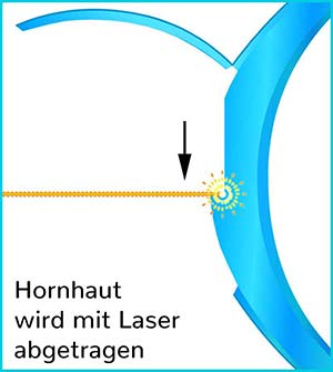 Femto-LASIK: Hornhaut wird mit Laser abgetragen