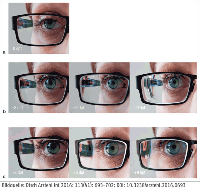 Brille - Dioptrien-Unterschied, von außen gesehen