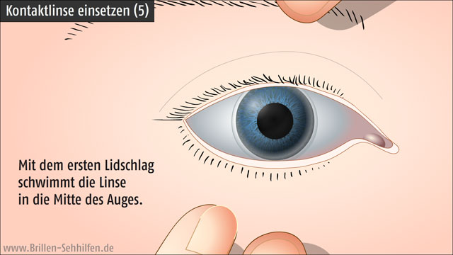 Kontaktlinsen eingesetzt