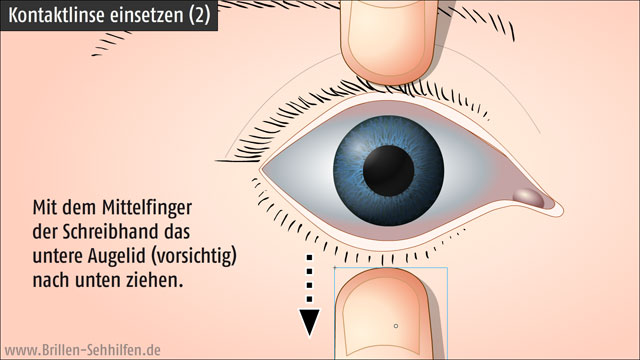 Kontaktlinsen einsetzen (2): Unteres Augelid hochziehen