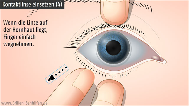 Kontaktlinsen einsetzen (4): Linse auf Auge