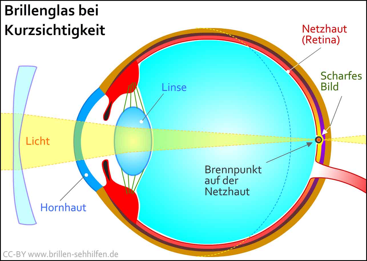Umrechnen brillenstärke kontaktlinsen Umrechnung Brillenwerte